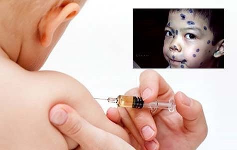 Tiêm vắc xin giúp phòng ngừa bệnh thủy đậu hiệu quả và đơn giản